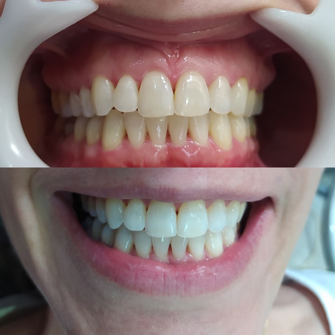 Antes e depois de tratamento odontológico